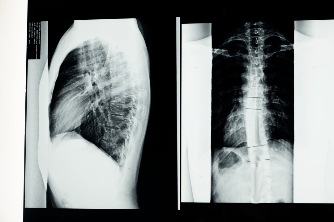 osteohondroza vratne hrbtenice na sliki