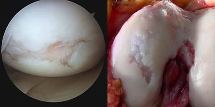 med operacijo je vidna poškodba kolenskega sklepa