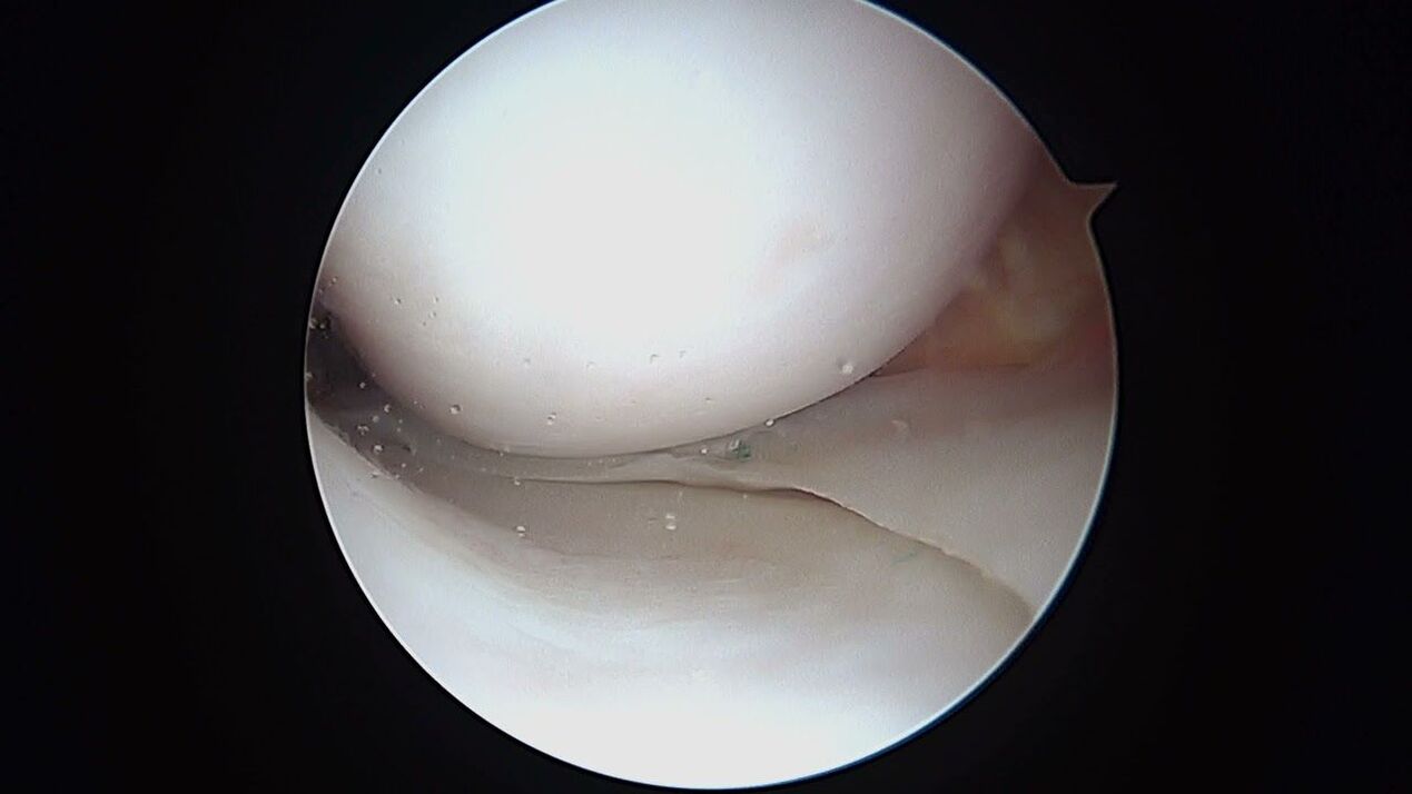 pogled na kolenski sklep skozi artroskop