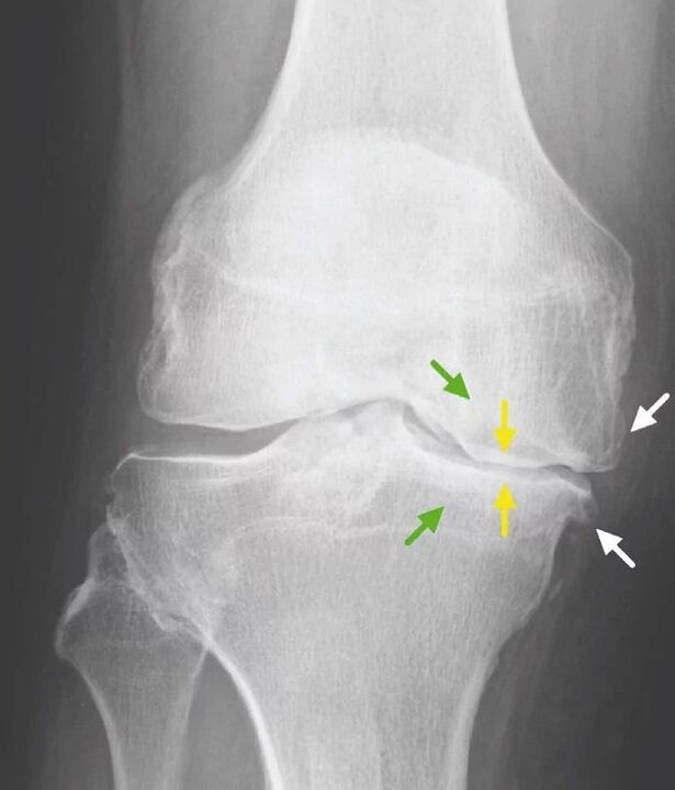 poškodba kolena