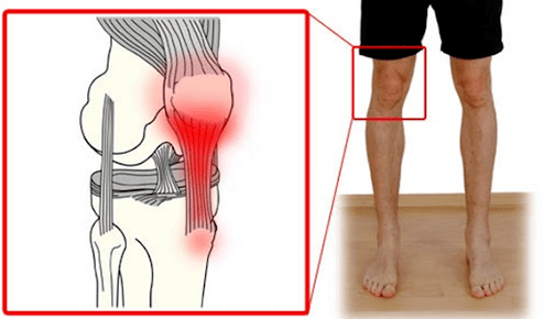 Tendinitis je vnetje kitnega tkiva, ki povzroča bolečino v kolenskem sklepu. 
