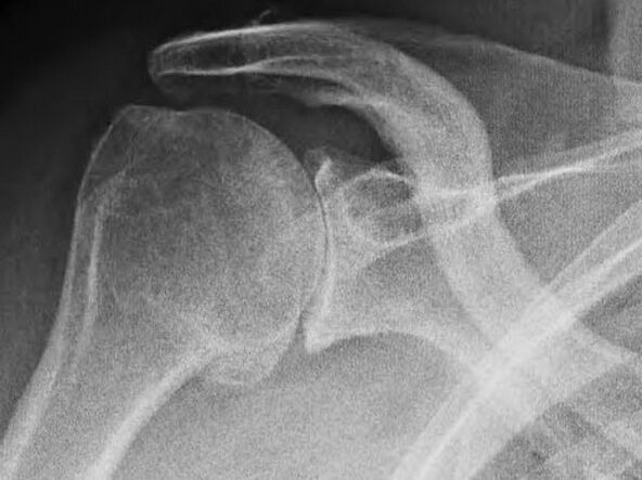 Rentgenska slika ramenskega sklepa, prizadetega z artrozo