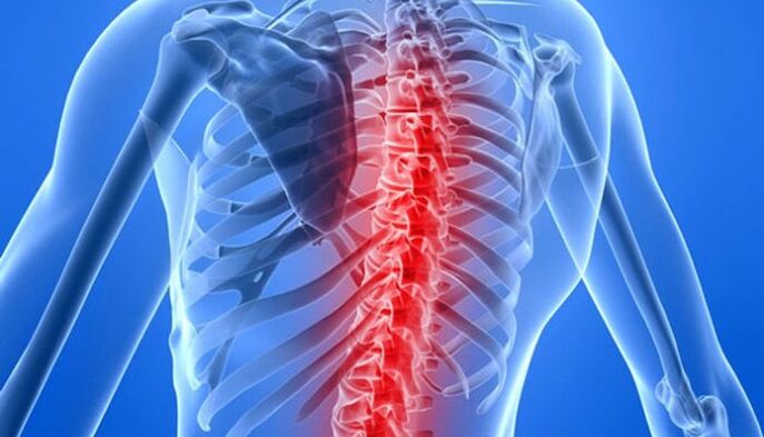 Patologije hrbtenice so najpogostejši vzroki za bolečine v hrbtu v predelu lopatic