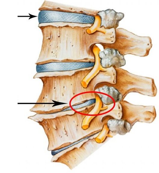 Osteohondroza materničnega vratu