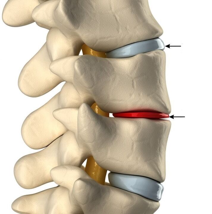 razlika med zdravim diskom in diskom z osteohondrozo