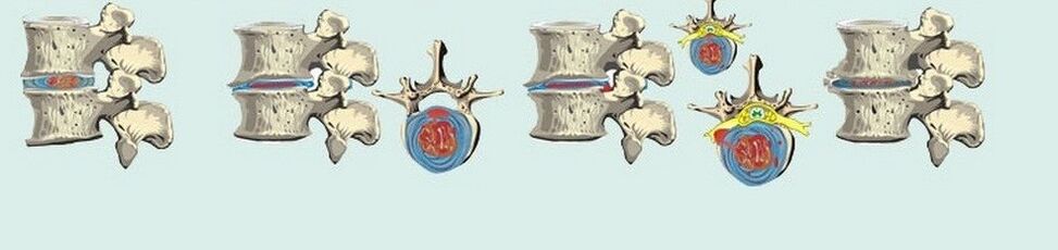 različne stopnje torakalne osteohondroze