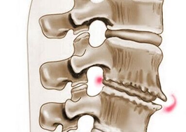 poškodbe vretenc pri torakalni osteohondrozi