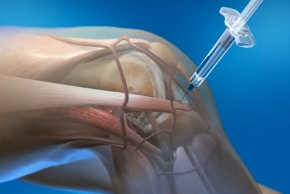 intraartikularne injekcije za artrozo kolenskega sklepa