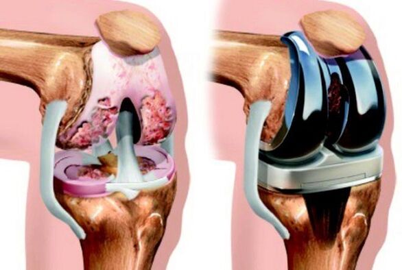 pred in po artrozi kolenskega sklepa zaradi artroze